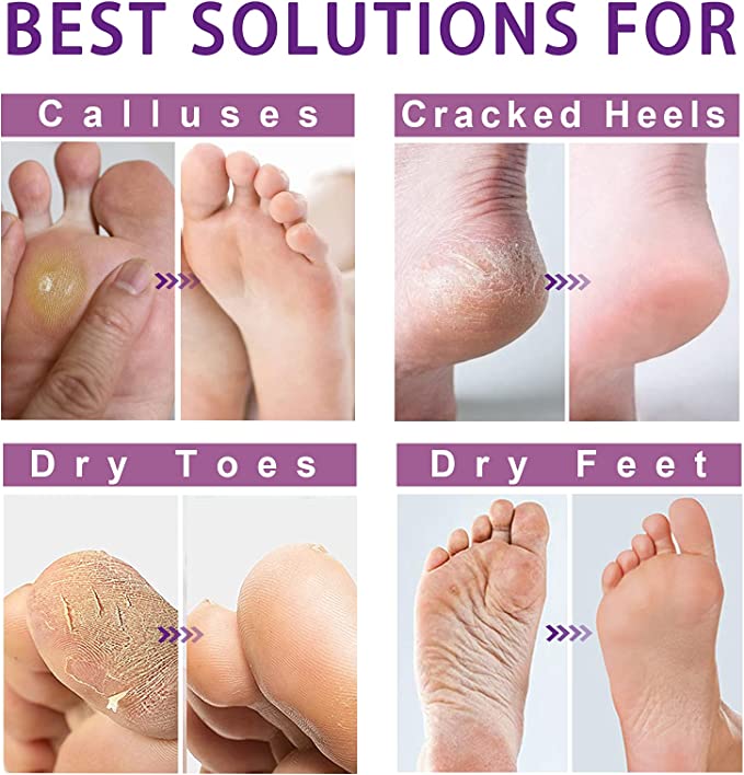 Why Are My Feet So Dry?, Natural Foot Peel