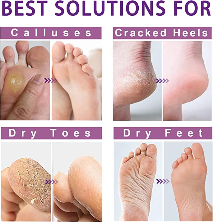 Foot Peel Mask - Exfoliator Peel Off Calluses Dead Skin Callus Remover